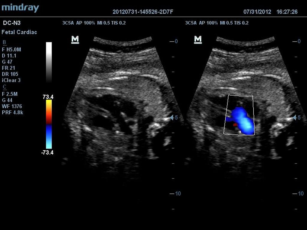 Fetal Left Vetricular Outflow Tract