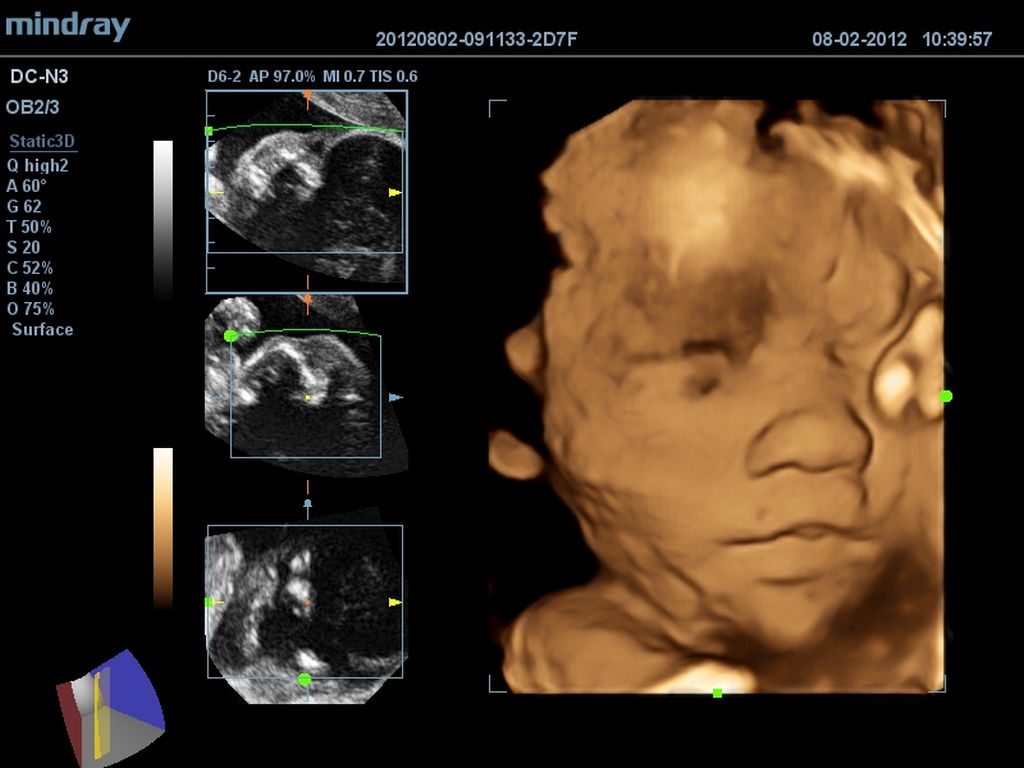 Fetal face 4D