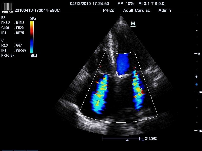 Mitral & Tricuspid Regurgitation x