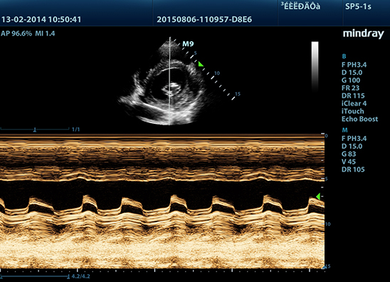 sp5-1_sax_mv-stenosis_m