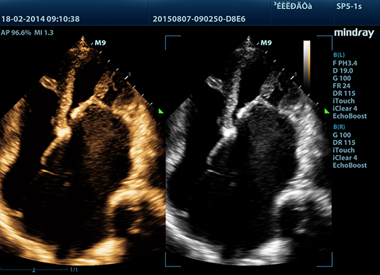 sp5-1s_4c_mv-stenosis_dual-b