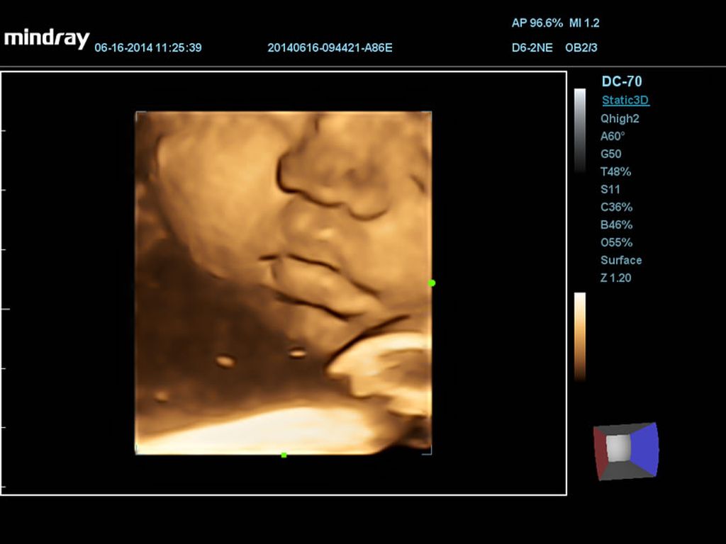 3D Fetal Month
