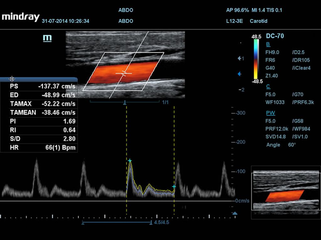 Triplex CCA with PW Auto Trace and Calculation Triplex CCA with PW Auto Trace and Calculation