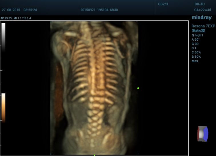 D8-4U-Fetal Spine-3D-3
