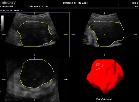 Smart Bladder