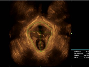 Smart Pelvic Automatické meranie hiatus levator ani