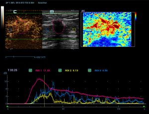 Breast Mass CEUS