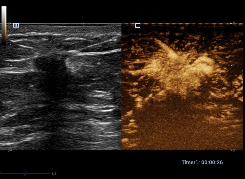 CEUS Breast Malignant