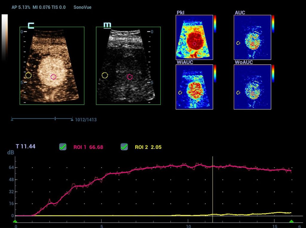 CEUS QA Liver HCC