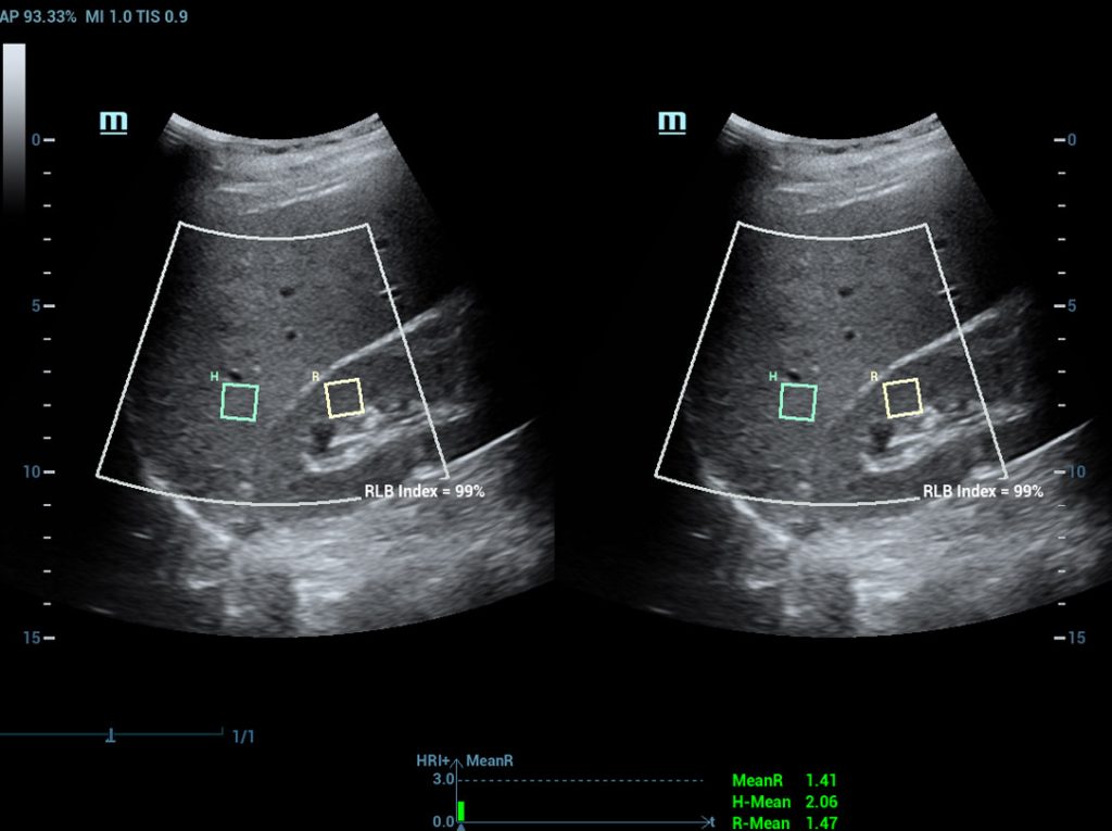 HepatoRenal Index