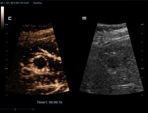 Liver Mass CEUS