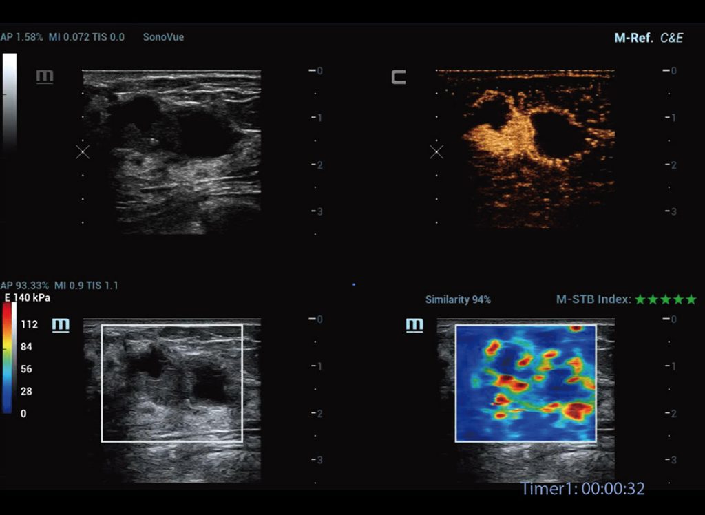 M-Ref. C&E Breast Malignant