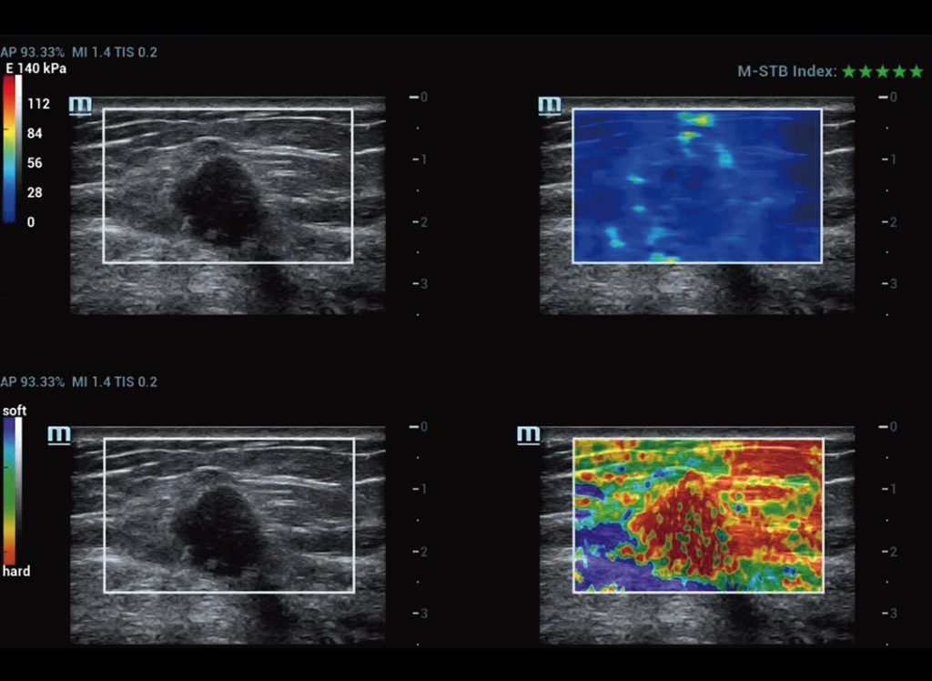 M-Ref. E Compare Breast Malignant