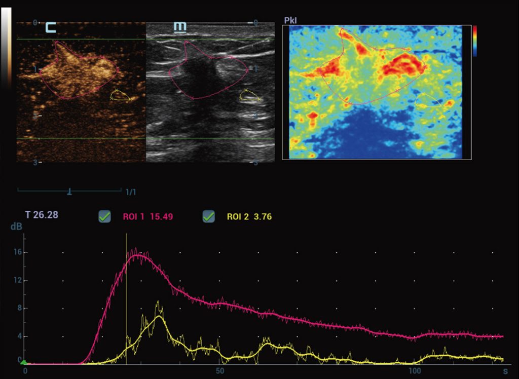 New CEUS QA Breast Malignant