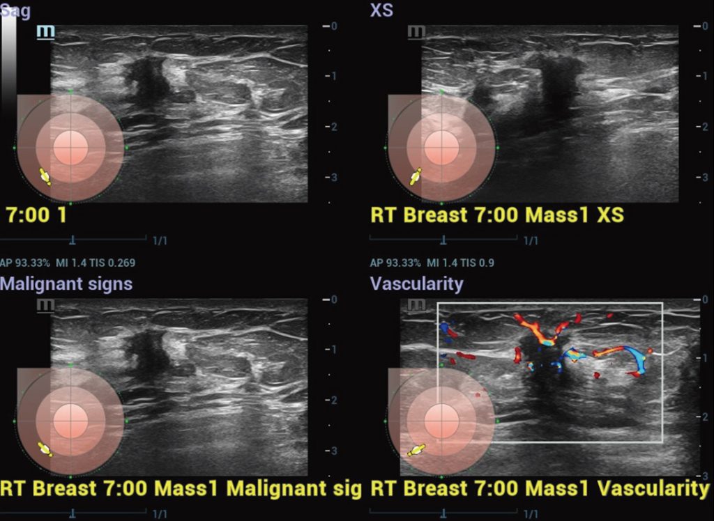 Smart Breast Malignant