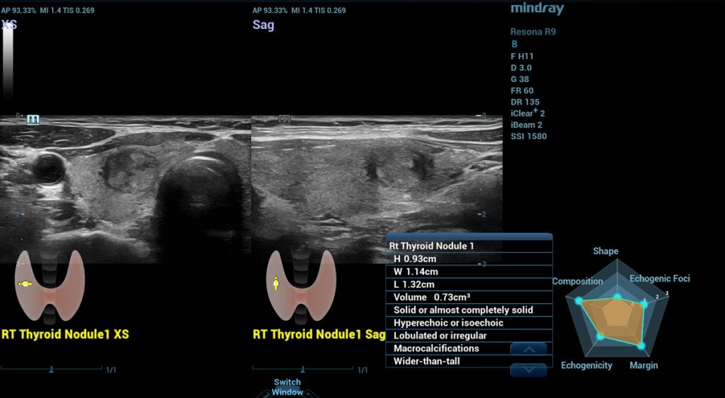 Smart Thyroid Nodule