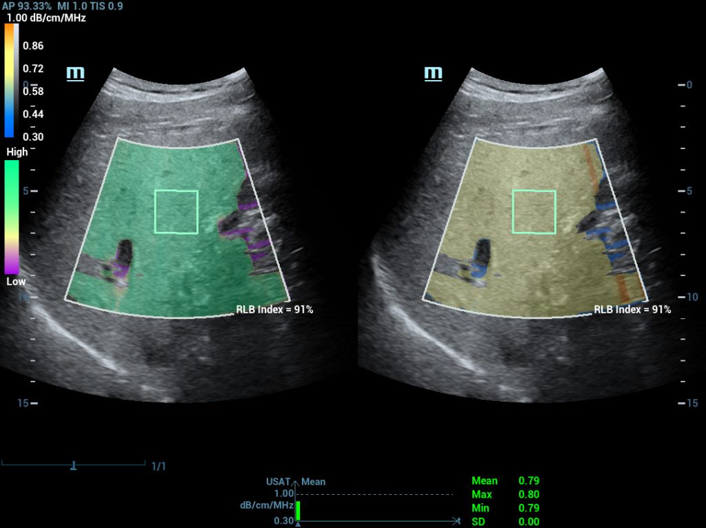 UltraSound ATtenuation Analysis (USAT)