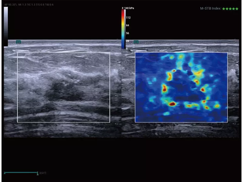 Breast-Carcinoma-STE