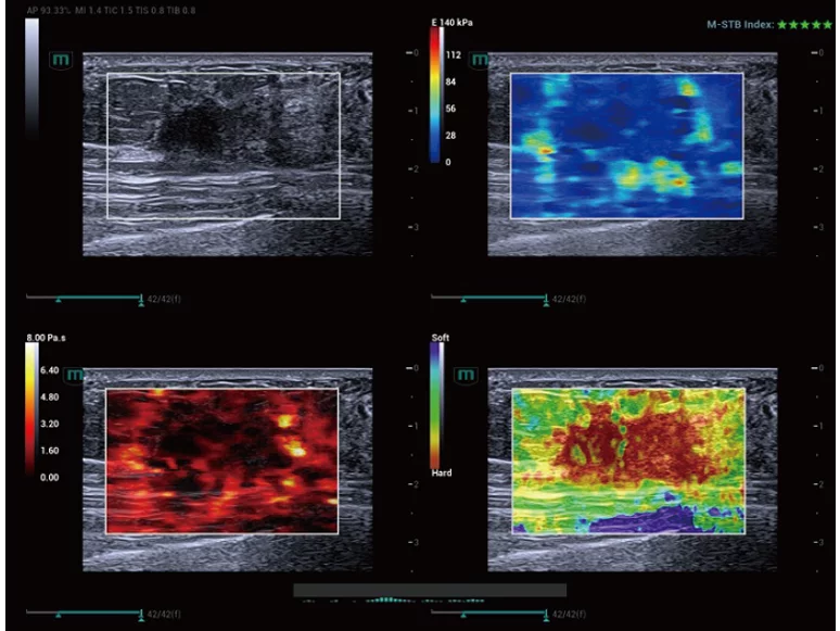 Breast-Lesion