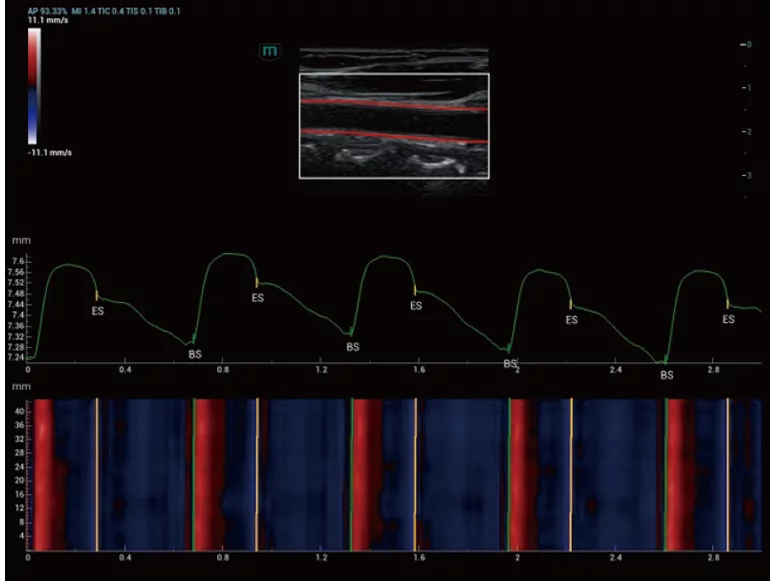 Carotid-Artery-Holo-PWV