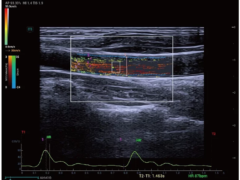 Carotid-Artery-V-Flow