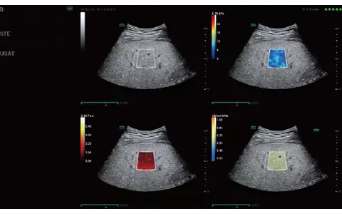 Fatty-Liver