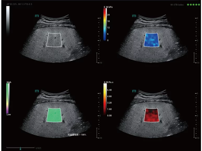 Fatty-Liver