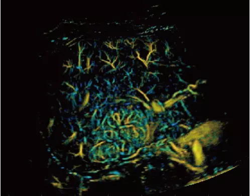 Focal-Nodular-Hyperplasia-Direction-Map