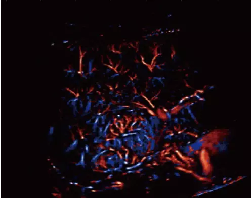 Focal-Nodular-Hyperplasia-Velocity-Map